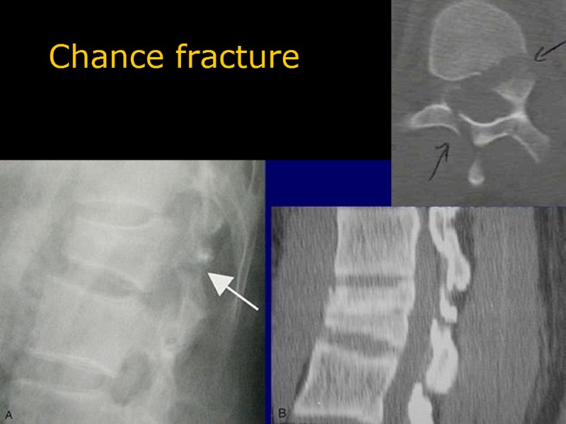 Chance fracture